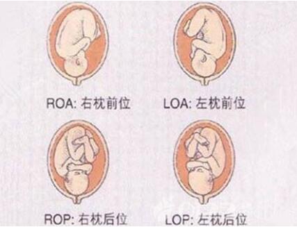 胎位roa和loa各是什么意思