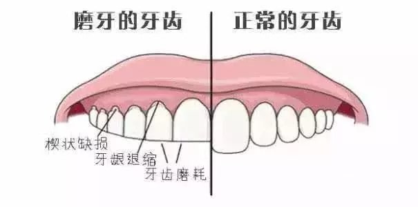 小孩晚上睡觉磨牙的危害