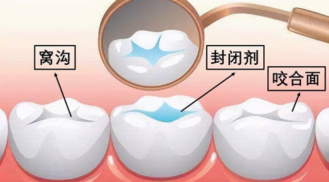 牙齿窝沟封闭是什么意思